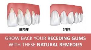 home remes for gum disease