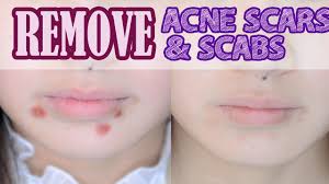 how to remove acne scars scabs you