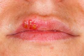 let s talk honestly about cold sores