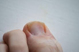 what is causing your ingrown toenail
