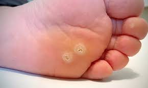 plantar warts for american fork and
