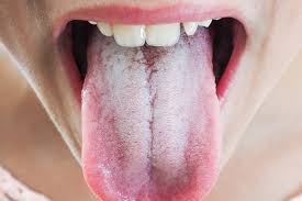 burning tongue 5 common causes how