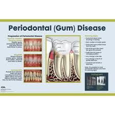 Dental Wall Art Periodontal Disease Chart 24x36 Daw014lu