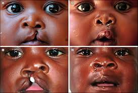 cleft deformities in zimbabwe africa