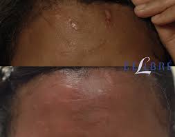 laser treatment for dark skin