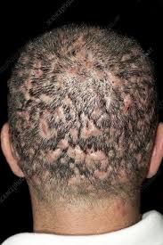 scalp folliculitis according to the nhs