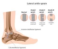 treat ankle sprains in soccer