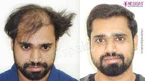 hair transplant cost in bangalore hair