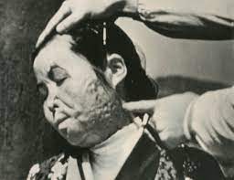 原子爆弾 で顔の左半分がケロイドとなり引きつった被爆者の女性＝1945年12月～46年4月頃、米軍撮影（6164）－ナガサキ、フィルムの記憶：朝日新聞デジタル