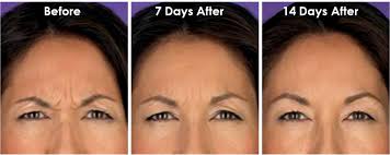 botox cosmetic beverly hills los