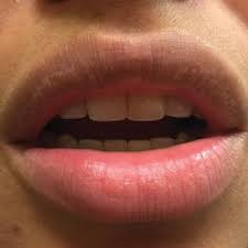 small white spots on the lips mdedge