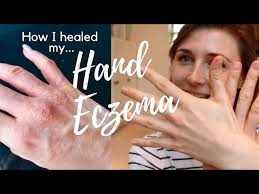 hand eczema treatment natural cure 7