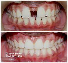 Retainers keep the teeth in place and prevent diastemas from recurring. Closing Gaps With Dental Braces Dr Nick Simon S Six Month Smiles Blog