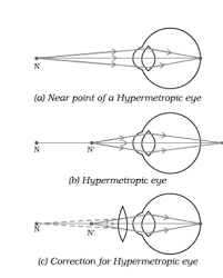 When Do We Consider A Person To Be Myopic Or Hypermetropic