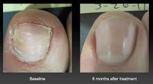 toenail fungus treatment