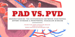 Understanding The Differences Between Pad Vs Pvd Usa