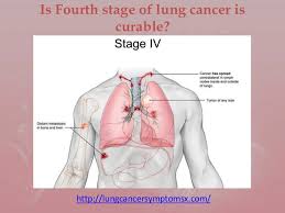 Tumor with pleural nodules or malignant pleural (or pericardial) effusion. Is Fourth Stage Of Lung Cancer Is Curable