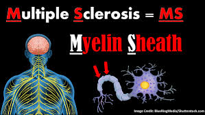 Multiple sclerosis (ms) is a chronic inflammatory condition. Multiple Sclerosis Ms Nclex Review