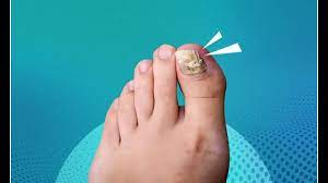 best toenail fungus treatments of 2023