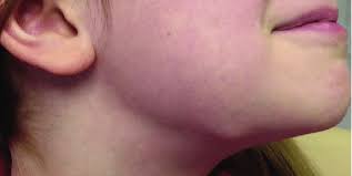 patient with an enlarged lymph node