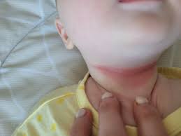 rash under chin from drool babycenter