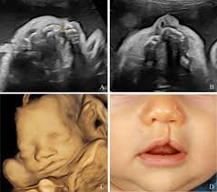 prenatal detection of clefts