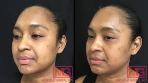 acne scar discoloration treatment dr