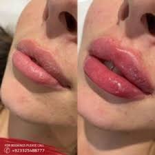 russian lip fillers in abad