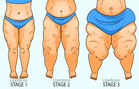 do s and don ts of living with lipedema