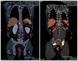 This type of diagnostic imaging procedure / treatment is relatively affordable, especially in philippines. The Role Of Psma Pet Ct And Pet Mri In Diagnosing Prostate Carcinoma Military Medicine Worldwide