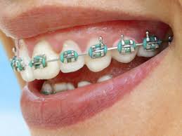 Repeat the process several times a day for best results. Care And Use Of Braces Hallgren Orthodontics