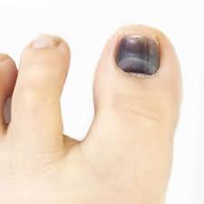 black toenails podiatrist in
