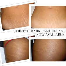 permanent body makeup for stretch marks