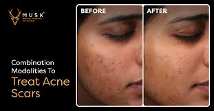combination modalities to treat acne scars