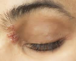 how shingles can affect your eyes