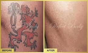 tattoo removal gallery perfect body