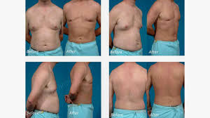 tumescent liposuction benefits