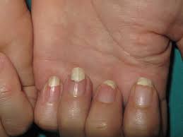 onycholysis in several nails that