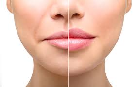 lip fillers post treatment care