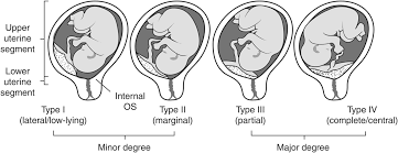 What are they types of placenta previa? Antepartum Haemorrhage Chapter 2 Antenatal Disorders For The Mrcog And Beyond