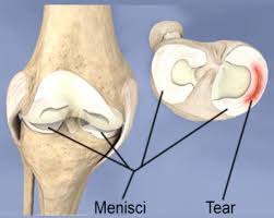 how to treat knee meniscus tear with