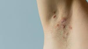 hidradenitis suppurativa and skin cancer