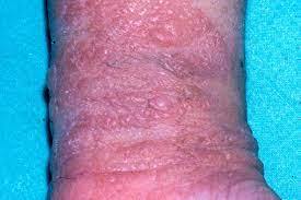 allergic contact dermais symptoms