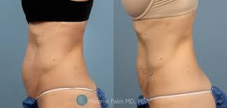 laser liposuction with accusculpt