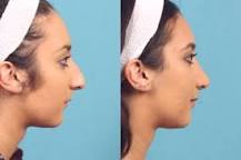 What is the best age for a nose job?