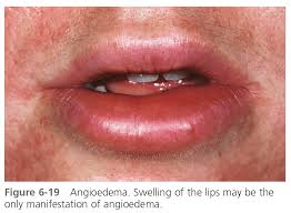 urticaria and angioedema