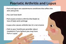 psoriatic arthritis vs lupus signs