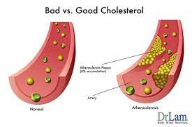 understanding high cholesterol a