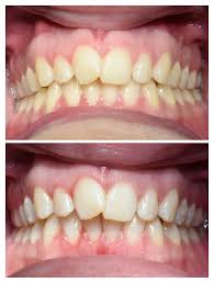 teeth whitening western dental hygiene