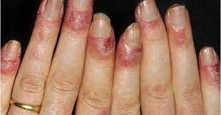 nail fold telangiectasia why and how